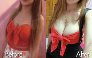 amrv-breast-augmentation-looksorn-00