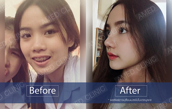 amrv-rhinoplasty-first