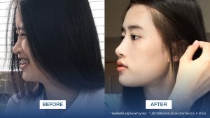 amrv-rhinoplasty-jane-6310-00