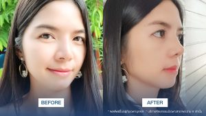 amrv-6401-00-rhinoplasty-koong-pimchanok