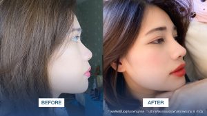 amrv-6401-00-rhinoplasty-nene-netiya