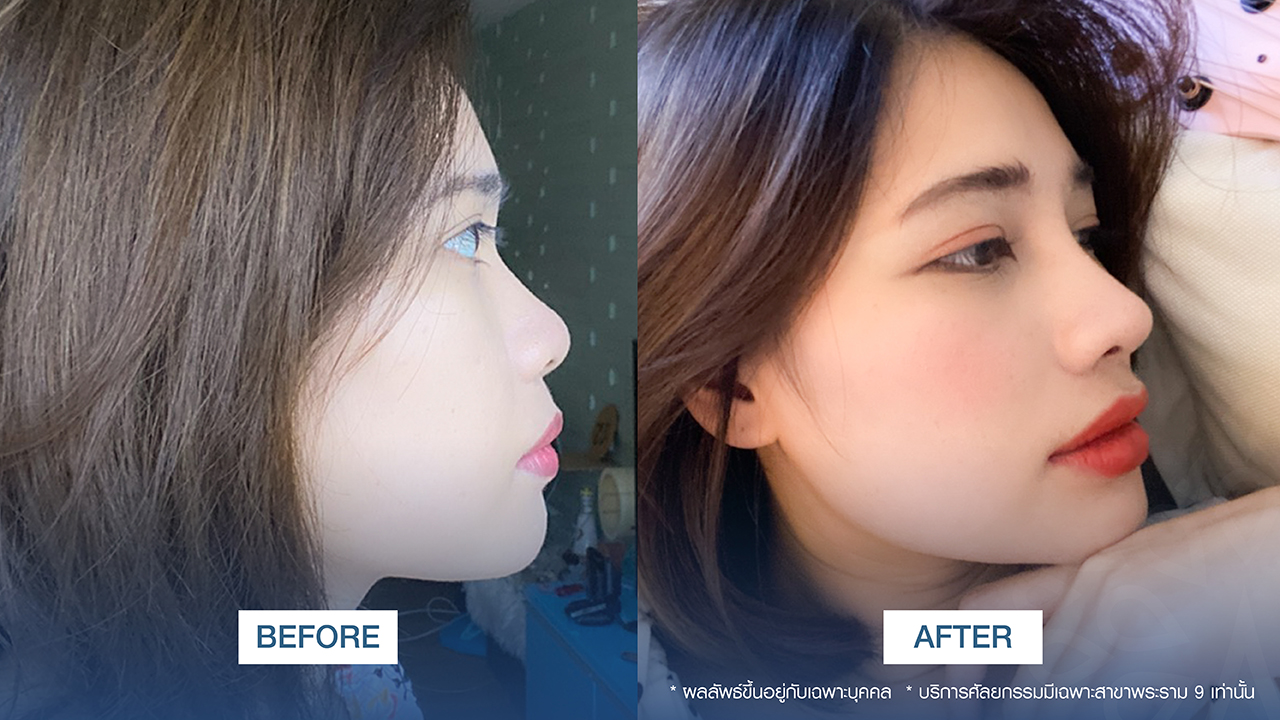 amrv-6401-00-rhinoplasty-nene-netiya
