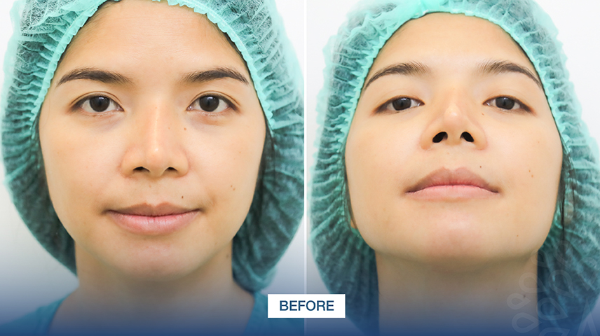 amrv-6401-02-rhinoplasty-koong-pimchanok