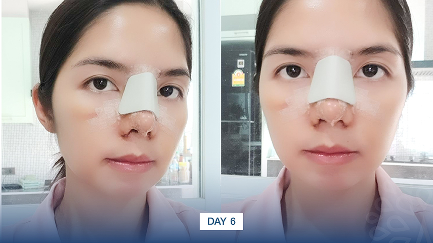 amrv-6401-03-rhinoplasty-koong-pimchanok